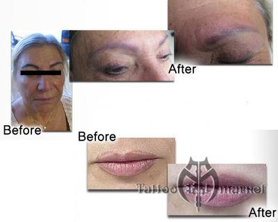 Cosmetic Tattoo Removal - Sold